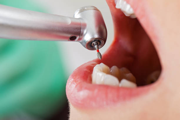 Best Emergency Tooth Extraction in North Manchester, IN